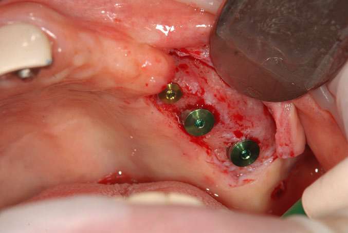 サイナスリフト後のインプラント手術3