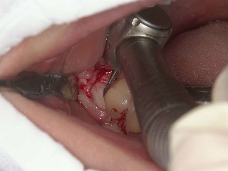 親知らず抜歯中の口腔内写真(頭と根っこを分割)